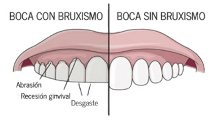 Qu es el bruxismo?